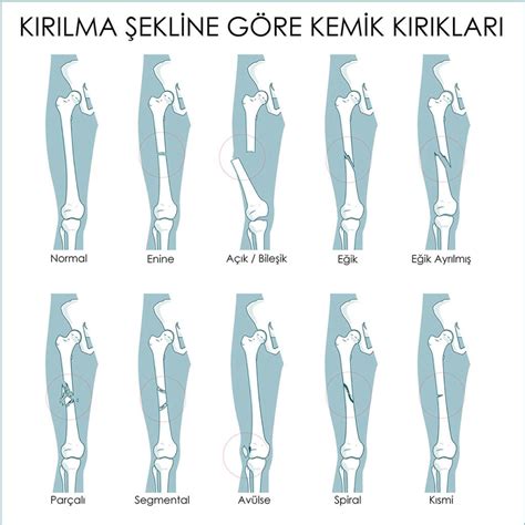 Spor ve Kemik Kırıkları: Egzersizin Kemik Yoğunluğunu Artırma ve Kırık Riskini Azaltma Potansiyeli